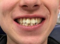 Alex before